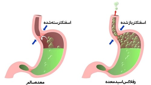 ریفلاکس معده؛ دلایل، علائم و بهترین روشهای درمان رفلاکس معده