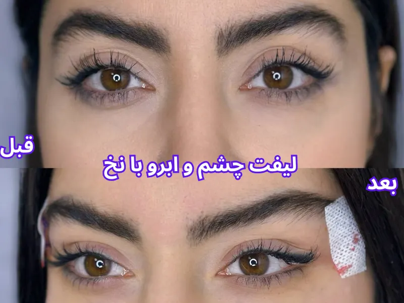 لیفت با نخ