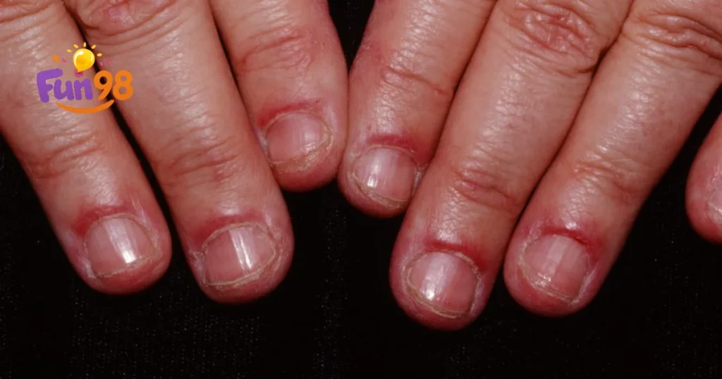 اسکلرودرمی موضعی (Localized Scleroderma)