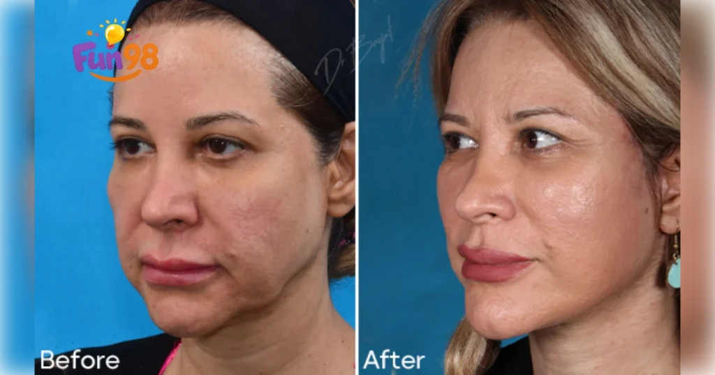 مکانیسم اثر وایتالیفت؛ تحریک کلاژن&zwnj;سازی و لیفتینگ با نخ