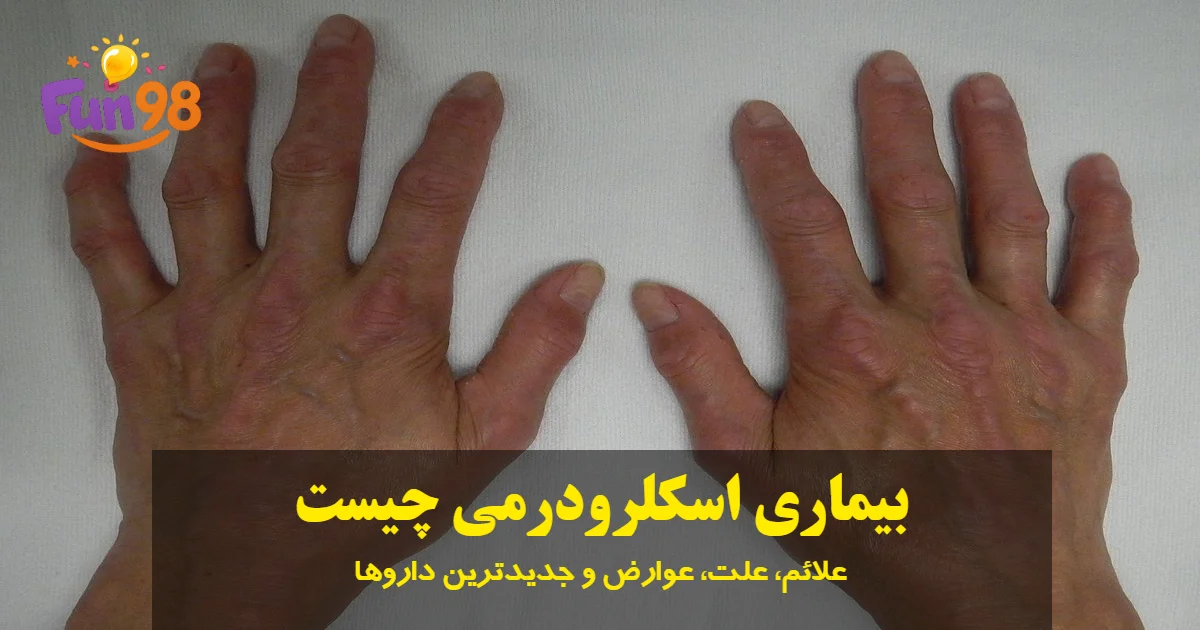 بیماری اسکلرودرمی چیست