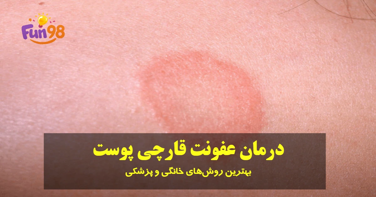 درمان عفونت قارچی پوست
