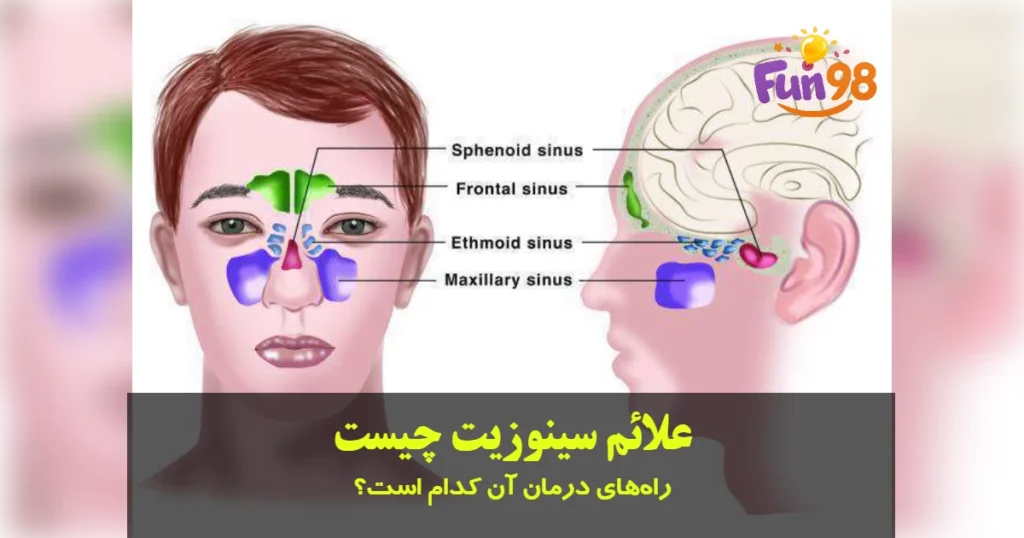 علائم سینوزیت چیست