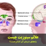 علائم سینوزیت چیست
