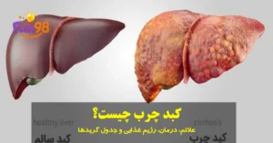 کبد چرب چیست